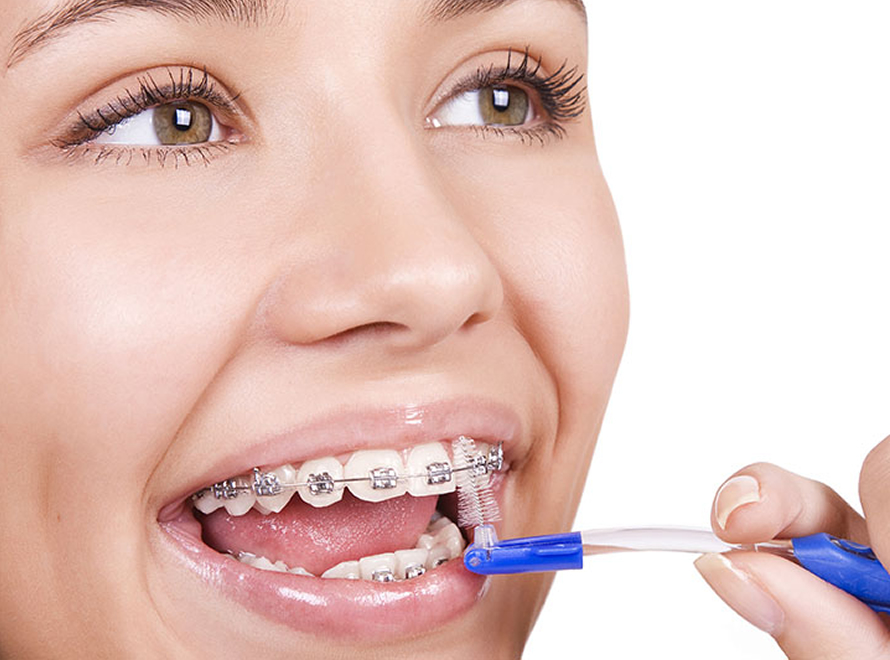 COMO HACER UNA BUENA LIMPIEZA DE LOS BRAKETS